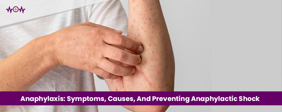anaphylaxis-symptoms-causes-and-preventing-anaphylactic-shock