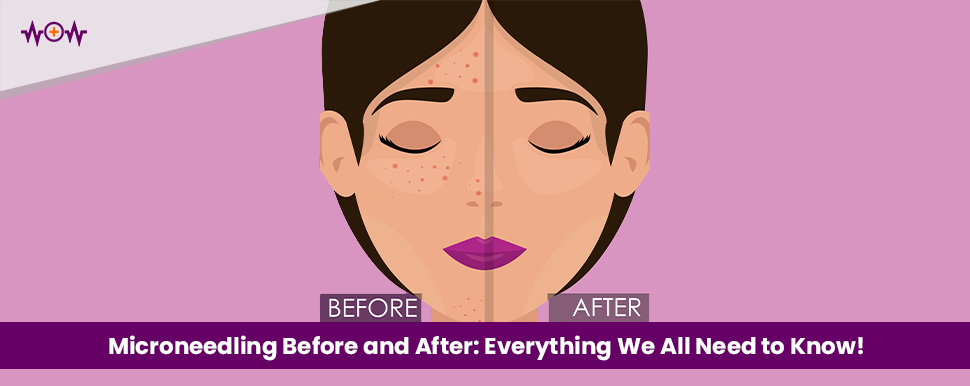 microneedling-before-and-after-everything-we-all-need-to-know