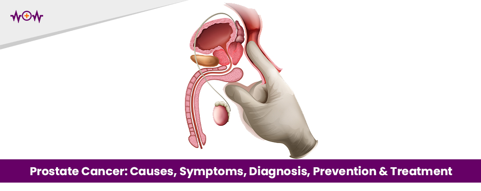 prostate-cancer-causes-symptoms-diagnosis-prevention-treatment