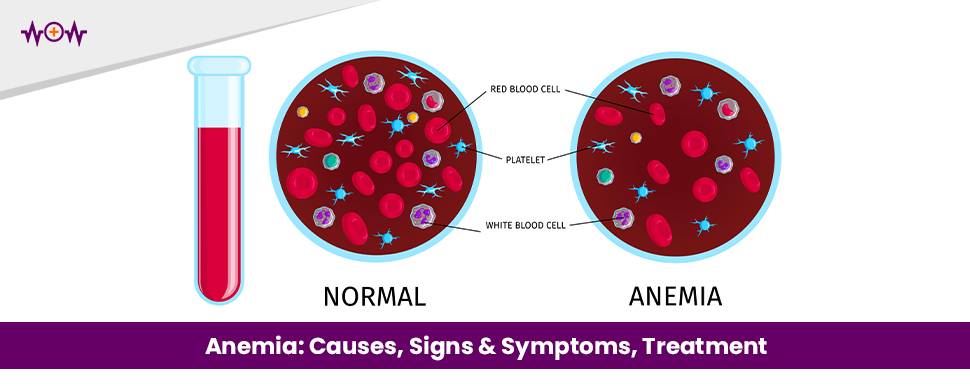 anemia-causes-signs-symptoms-treatment