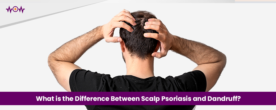 what-is-the-difference-between-scalp-psoriasis-and-dandruff