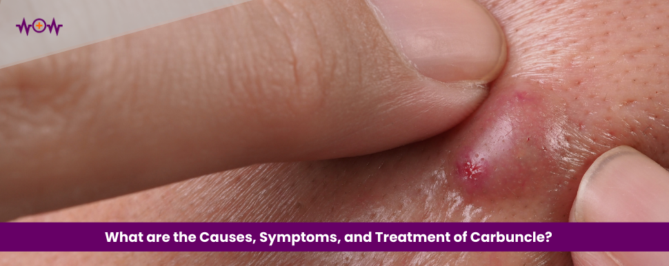 what-are-the-causes-symptoms-and-treatment-of-carbuncle