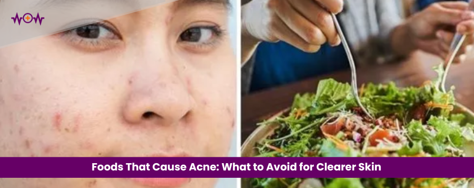 foods-that-cause-acne-what-to-avoid-for-clearer-skin