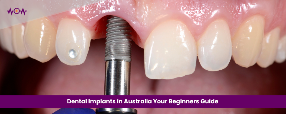 beginners-guide-to-dental-implants