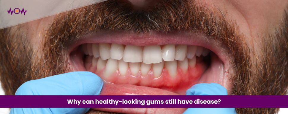 why-can-healthy-looking-gums-still-have-disease