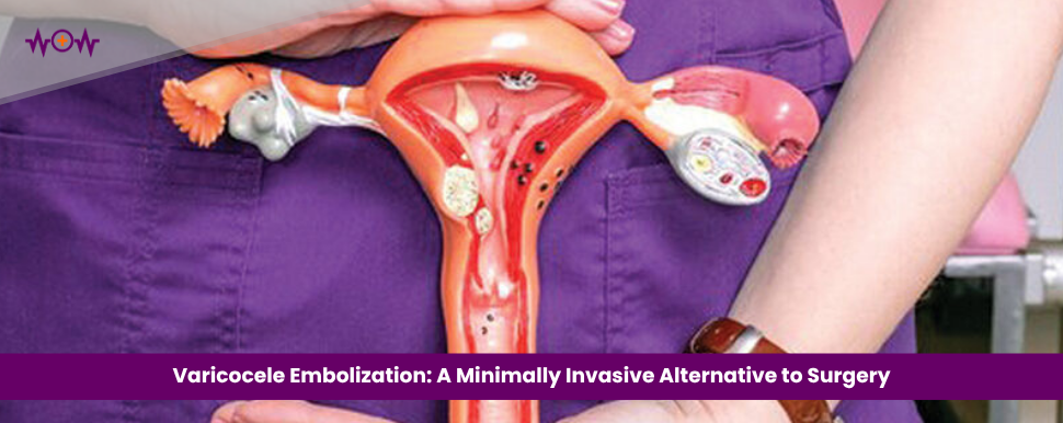 varicocele-embolization-a-minimally-invasive-alternative-to-surgery